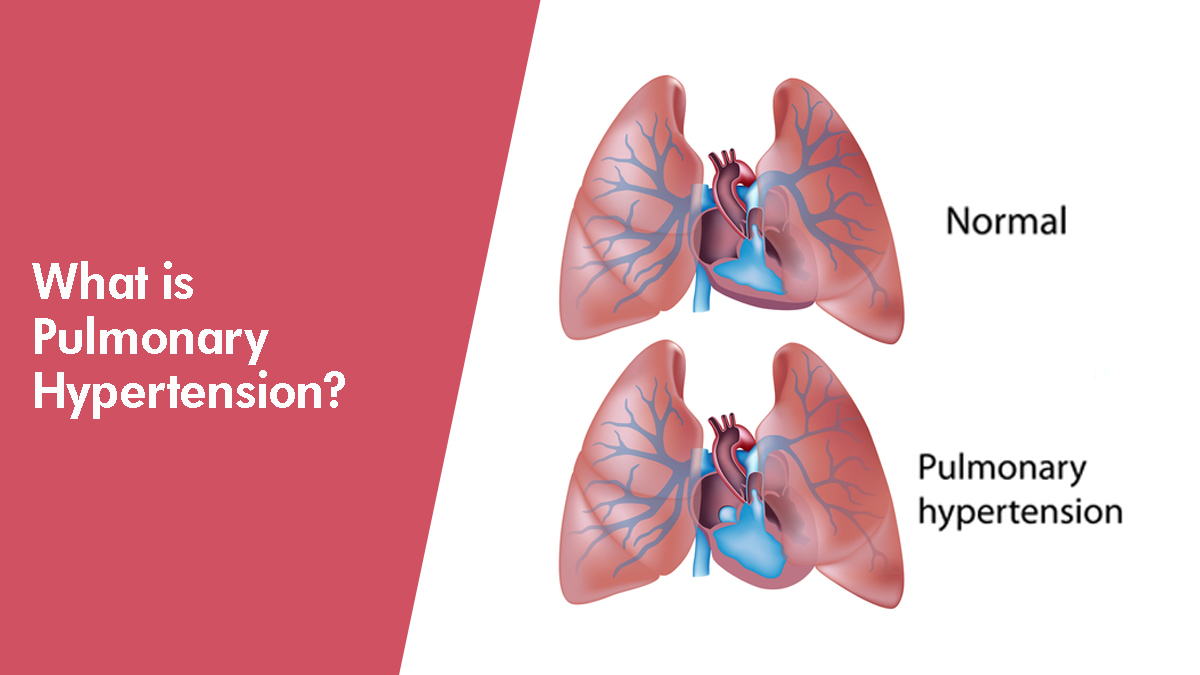 How to cope with pulmonary hypertension - Promo Numenta